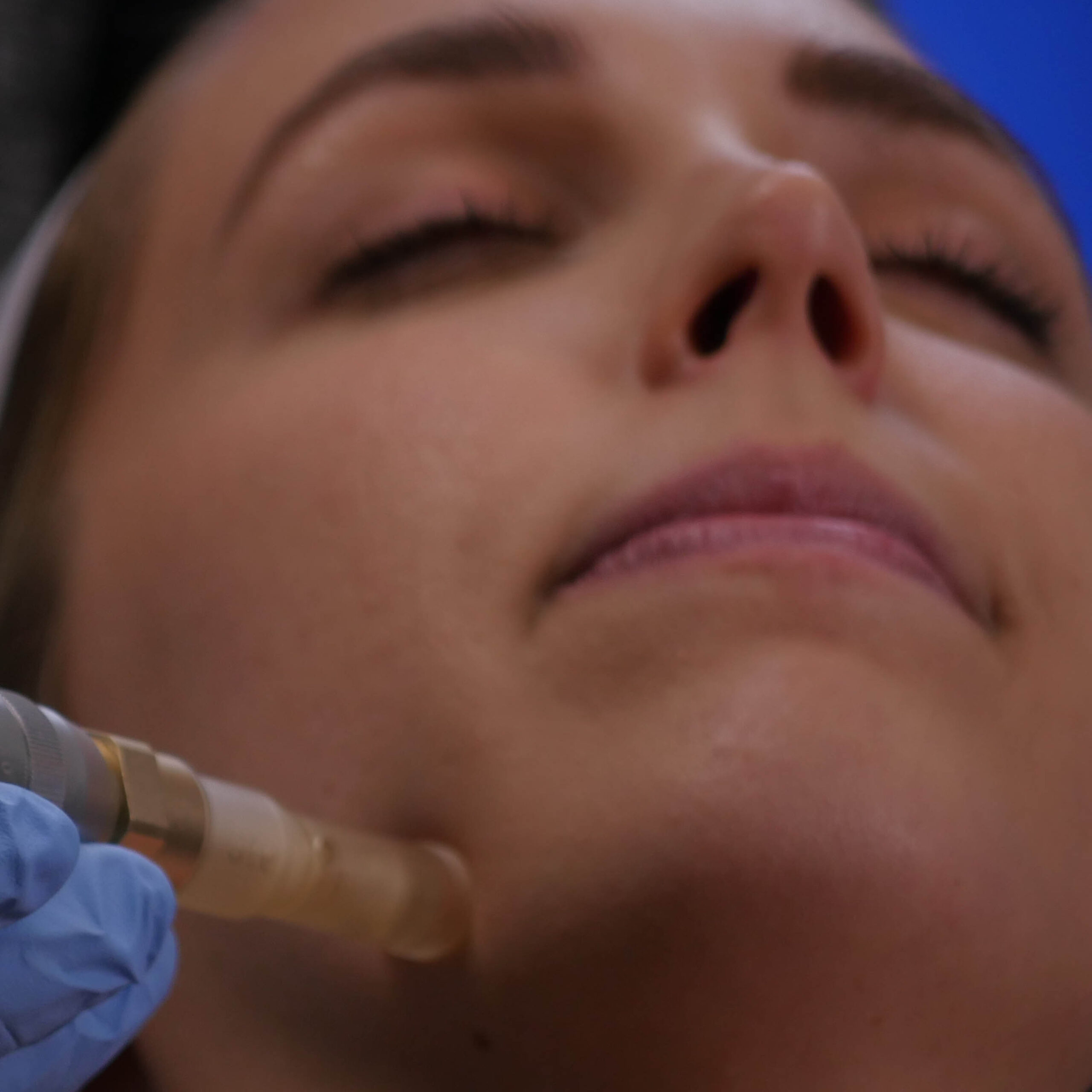 What is the Cost of Microneedling?